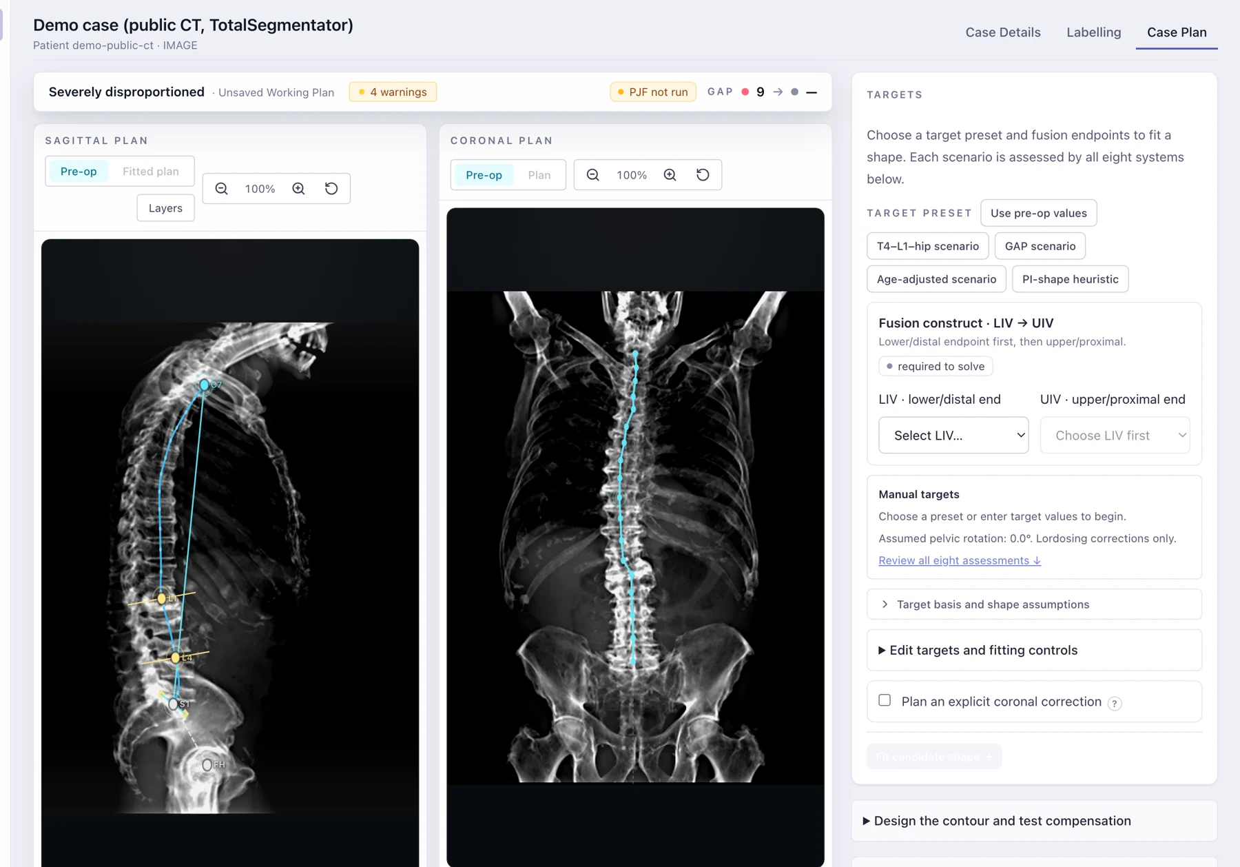 Zyra plan workspace: sagittal and coronal plan views over the radiographs, with target presets and the fusion construct picker